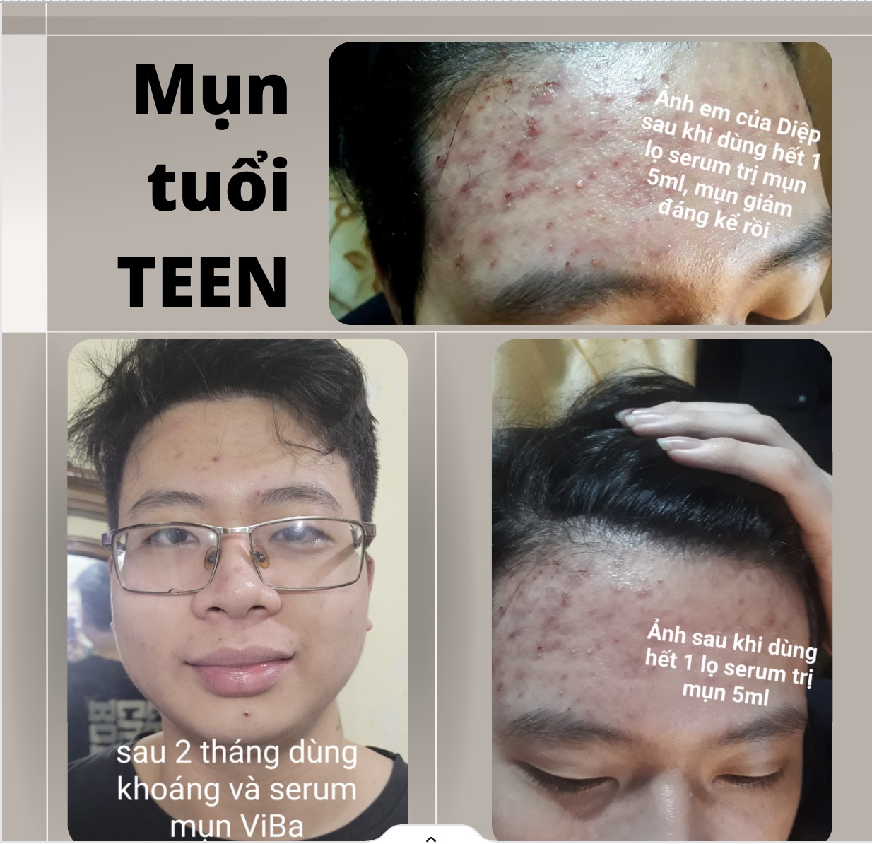 Feedback MỤN TUỔI TEEN